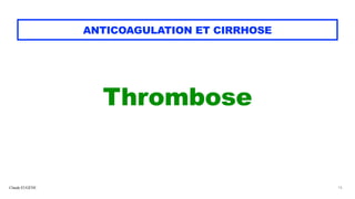 Claude EUGÈNE
ANTICOAGULATION ET CIRRHOSE
Thrombose


16
 