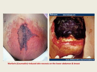 Warfarin (Coumadin)–induced skin necrosis on the lower abdomen & breast
 