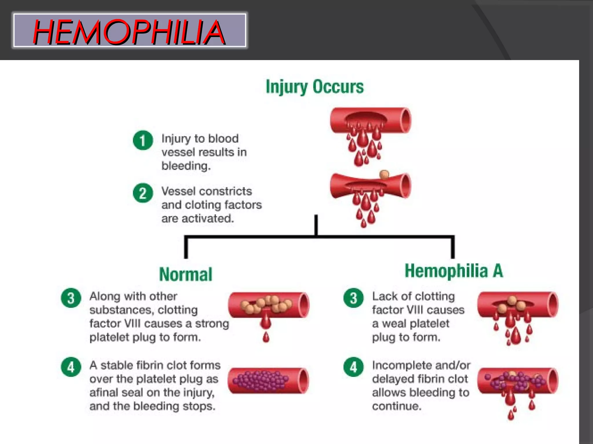 HEMOPHILIAHEMOPHILIA
 