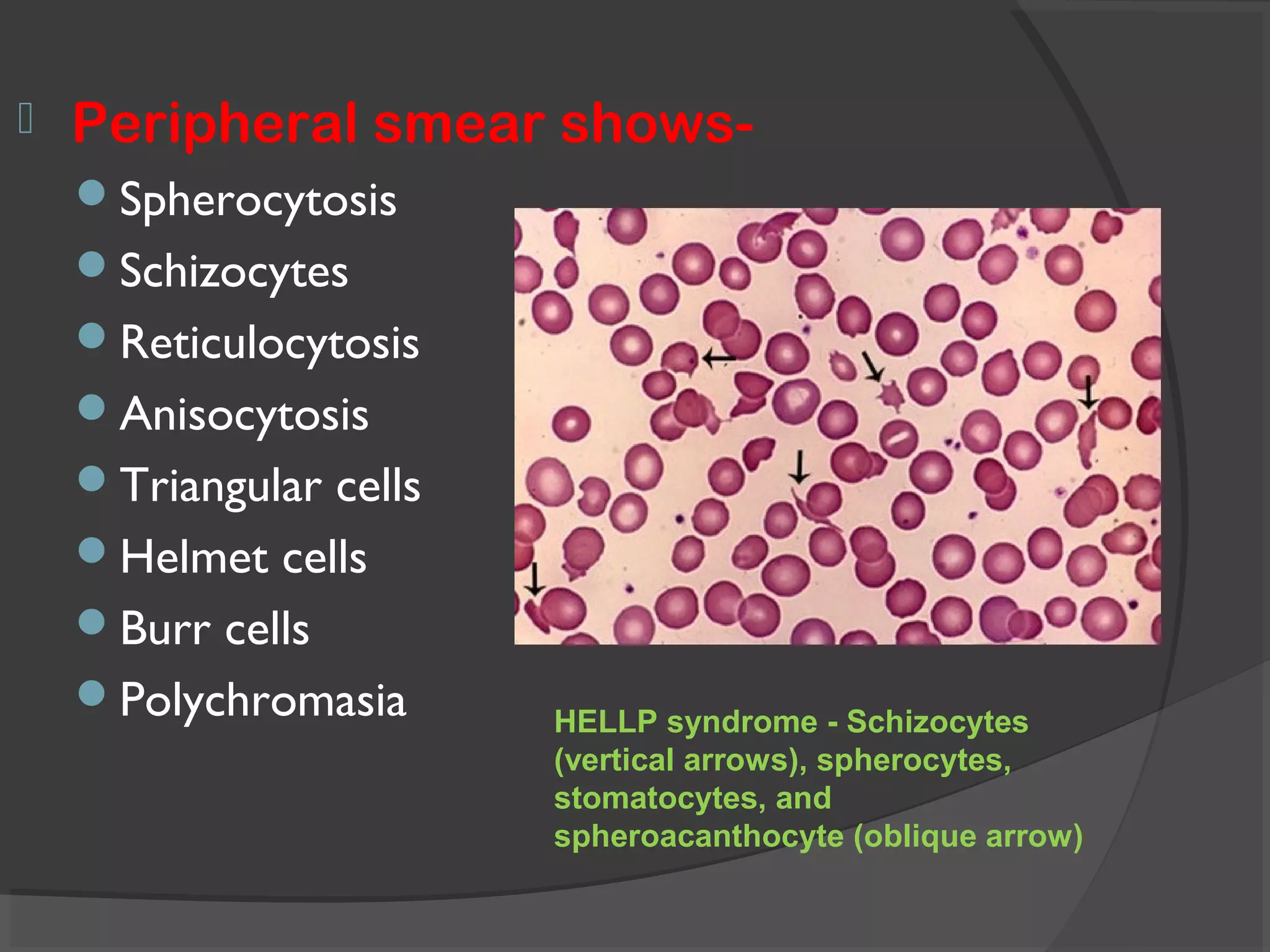  Peripheral smear shows-
Spherocytosis
Schizocytes
Reticulocytosis
Anisocytosis
Triangular cells
Helmet cells
Burr cells
Polychromasia HELLP syndrome - Schizocytes
(vertical arrows), spherocytes,
stomatocytes, and
spheroacanthocyte (oblique arrow)
 