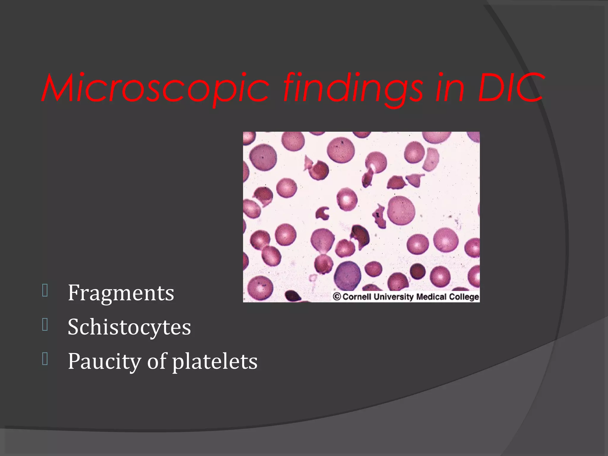 Microscopic findings in DIC
 Fragments
 Schistocytes
 Paucity of platelets
 