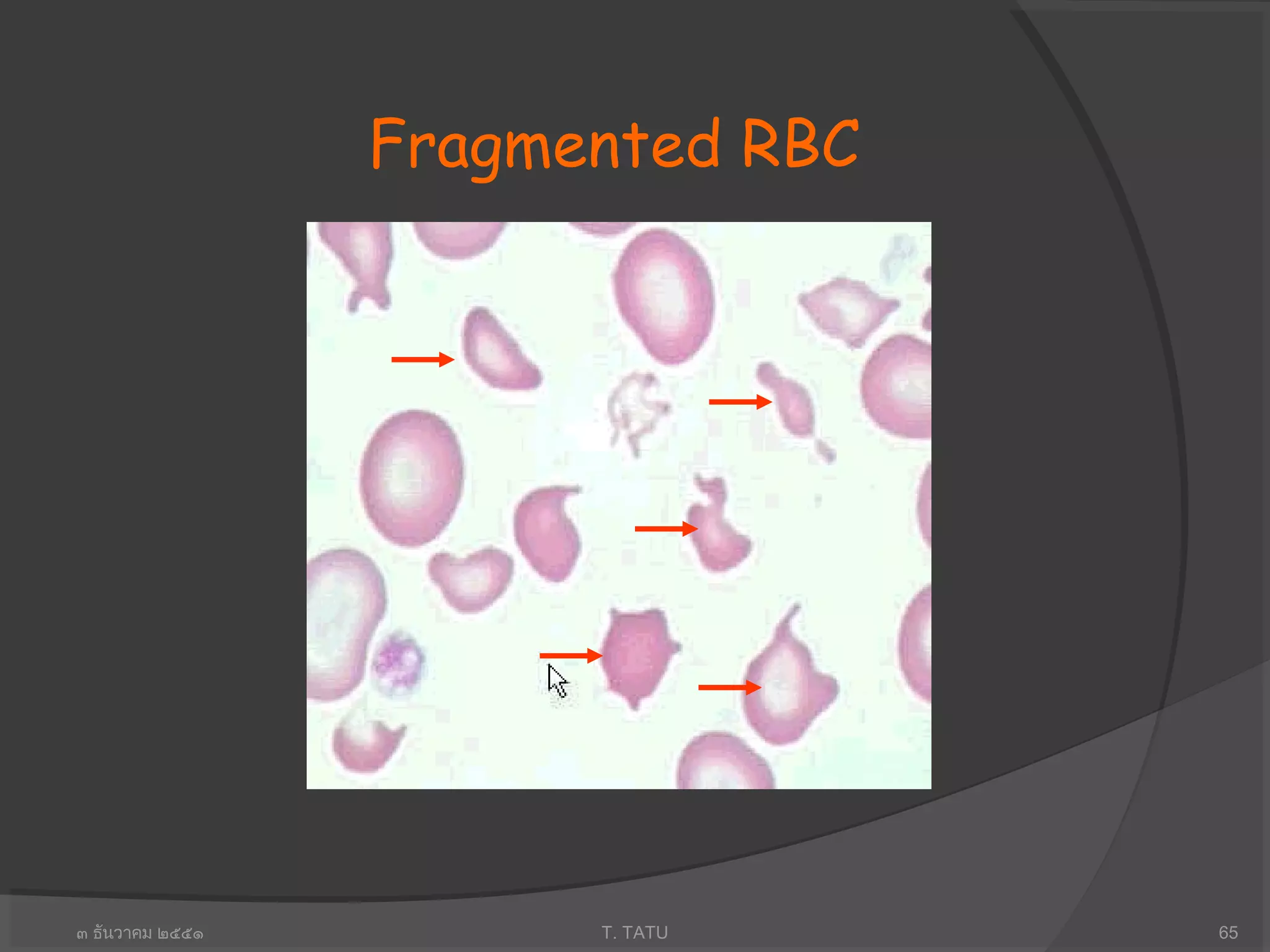 ๓ ธันวาคม ๒๕๕๑ T. TATU 65
Fragmented RBC
 