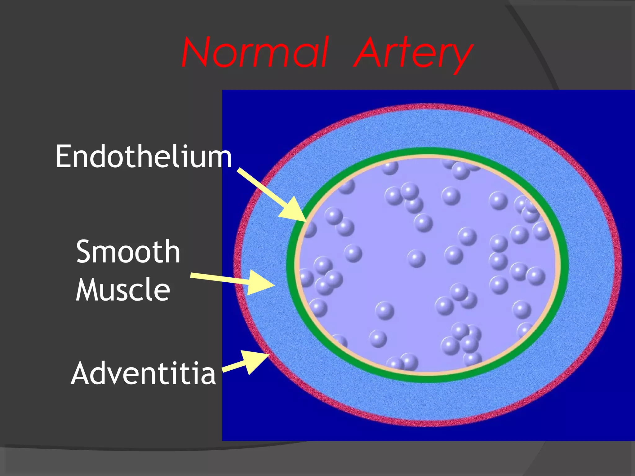 Normal Artery
Endothelium
Smooth
Muscle
Adventitia
 