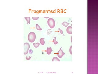 Coagulation failure in pregnancy | PPT
