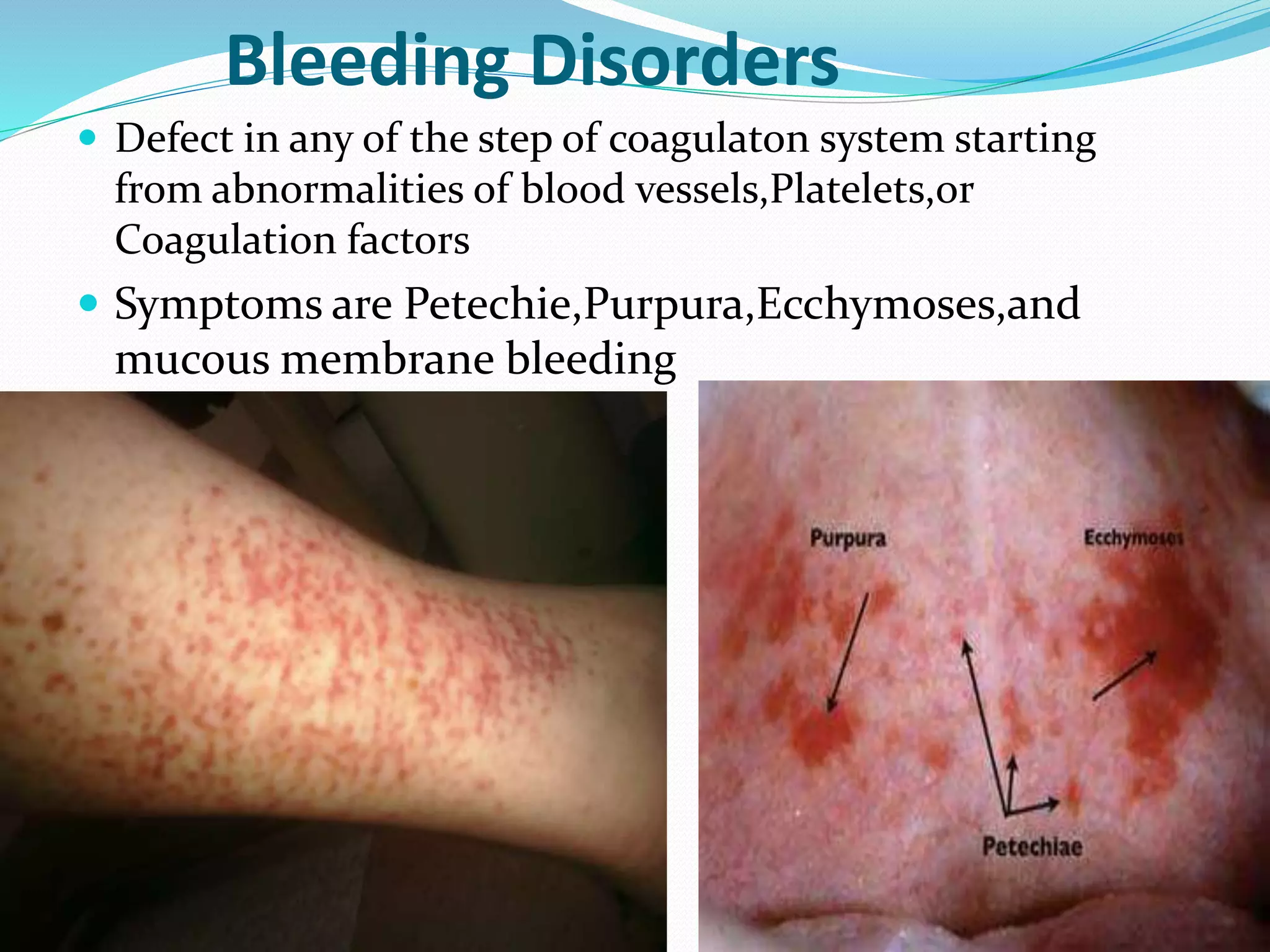 Bleeding Disorders 
 Defect in any of the step of coagulaton system starting 
from abnormalities of blood vessels,Platelets,or 
Coagulation factors 
 Symptoms are Petechie,Purpura,Ecchymoses,and 
mucous membrane bleeding 
 