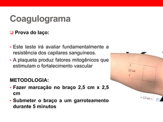 Coagulograma
 Prova do laço:
• Este teste irá avaliar fundamentalmente a
resistência dos capilares sanguíneos.
• A plaqueta produz fatores mitogênicos que
estimulam o fortalecimento vascular
METODOLOGIA:
• Fazer marcação no braço 2,5 cm x 2,5
cm
• Submeter o braço a um garroteamento
durante 5 minutos
 