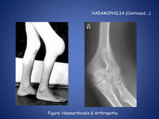HAEAMOPHILIA (Continued….)
Figure: Haemarthrosis & Arthropathy.
 