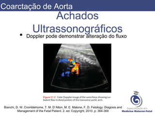 Achados
Ultrassonográficos
• Doppler pode demonstrar alteração do fluxo
Bianchi, D. W. Cromblehome, T. M. D’Alton, M. E. Malone, F. D. Fetology: Diagosis and
Management of the Fetal Patient. 2. ed. Copyright, 2010. p. 364-368
Coarctação de Aorta
 