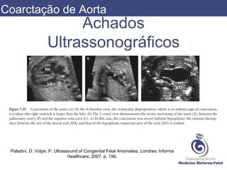 Achados
Ultrassonográficos
Paladini, D. Volpe, P. Ultrassound of Congenital Fetal Anomalies. Londres: Informa
Healthcare, 2007. p. 156.
Coarctação de Aorta
 