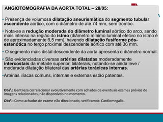 ANGIOTOMOGRAFIA DA AORTA TOTAL – 28/05:
• Presença de volumosa dilatação aneurismática do segmento tubular
ascendente aórtico, com o diâmetro de até 74 mm, sem trombo.
• Nota-se a redução moderada do diâmetro luminal aórtico do arco, sendo
mais intenso na região do istmo (diâmetro mínimo luminal efetivo no istmo é
de aproximadamente 6,5 mm), havendo dilatação fusiforme pós-
estenótica no terço proximal descendente aórtico com até 36 mm.
• O segmento mais distal descendente da aorta apresenta o diâmetro normal.
• São evidenciadas diversas artérias dilatadas moderadamente
intercostais da metade superior, bilaterais, notando-se ainda leve /
moderada dilatação bilateral das artérias torácicas internas.
•Artérias ilíacas comuns, internas e externas estão patentes.
Obs¹.: Gentileza correlacionar evolutivamente com achados de eventuais exames prévios de
imagens relacionados, não disponíveis no momento.
Obs².: Como achados de exame não direcionado, verificamos: Cardiomegalia.
 
