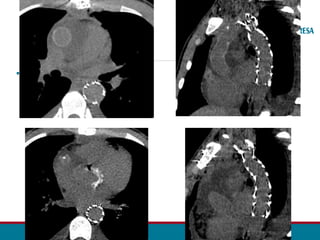•FOTOS ANGIO TC POS OP
 