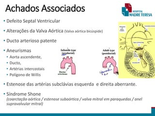 Achados Associados
• Defeito Septal Ventricular
• Alterações da Valva Aórtica (Valva aórtica bicúspide)
• Ducto arterioso patente
• Aneurismas
• Aorta ascendente,
• Ducto,
• Artérias intercostais
• Polígono de Willis
• Estenose das artérias subclávias esquerda e direita aberrante.
• Síndrome Shone
(coarctação aórtica / estenose subaórtica / valva mitral em paraquedas / anel
supravalvular mitral)
 