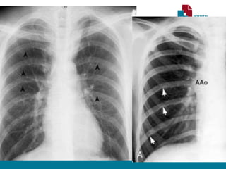 RADIOGRAFIA TORÁCICA
• Sinal de Roesler:
• Erosões bilaterais na borda inferior dos arcos costais (3ª - 9ª).
• Sinal do “ 3 invertido”
• Dilatação Subclávia E.
• Segmento estenótico aparece como um entalhe
• Dilatação pós estenótica.
• Contorno do arco aórtico apagado.
 