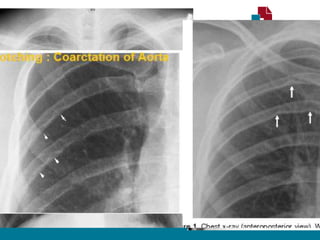 RADIOGRAFIA TORÁCICA
• Sinal de Roesler:
• Erosões bilaterais na borda inferior dos arcos costais (3ª - 9ª).
• Sinal do “ 3 invertido”
• Dilatação Subclávia E.
• Segmento estenótico aparece como um entalhe
• Dilatação pós estenótica.
• Contorno do arco aórtico apagado.
 