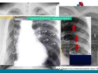 RADIOGRAFIA TORÁCICA
• Sinal de Roesler:
• Erosões bilaterais na borda inferior dos arcos costais (3ª - 9ª).
• Sinal do “ 3 invertido”
• Dilatação Subclávia E.
• Segmento estenótico aparece como um entalhe
• Dilatação pós estenótica.
• Contorno do arco aórtico apagado.
 