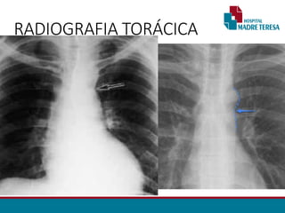 RADIOGRAFIA TORÁCICA
• Sinal de Roesler:
• Erosões bilaterais na borda inferior dos arcos costais (3ª - 9ª).
• Sinal do “ 3 invertido”
• Dilatação Subclávia E.
• Segmento estenótico aparece como um entalhe
• Dilatação pós estenótica.
• Contorno do arco aórtico apagado.
 