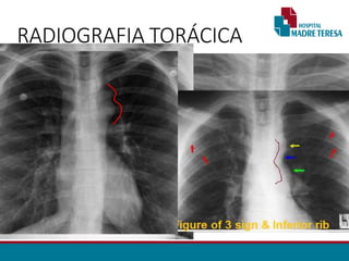RADIOGRAFIA TORÁCICA
• Sinal de Roesler:
• Erosões bilaterais na borda inferior dos arcos costais (3ª - 9ª).
• Sinal do “ 3 invertido”
• Dilatação Subclávia E.
• Segmento estenótico aparece como um entalhe
• Dilatação pós estenótica.
• Contorno do arco aórtico apagado.
 