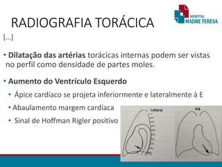 [...]
• Dilatação das artérias torácicas internas podem ser vistas
no perfil como densidade de partes moles.
• Aumento do Ventrículo Esquerdo
• Ápice cardíaco se projeta inferiormente e lateralmente à E
• Abaulamento margem cardíaca
• Sinal de Hoffman Rigler positivo
RADIOGRAFIA TORÁCICA
 