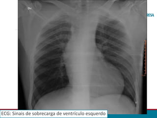 ECG: Sinais de sobrecarga de ventrículo esquerdo
 