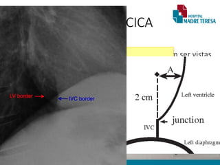 [...]
• Dilatação das artérias mamárias internas podem ser vistas
no perfil como densidade de partes moles.
• Aumento do Ventrículo Esquerdo
• Ápice cardíaco se projeta inferiormente e lateralmente à E
• Abaulamento margem cardíaca
• Sinal de Hoffman Rigler positivo
RADIOGRAFIA TORÁCICA
Sinal de Hoffman – Rigler ( > VE)
Extensão da borda posterior ventricular  1,8 cm
posteriormente à borda da Veia cava.
(medido à 2cm acima da intersecção VCI x diafragma)
 