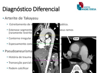 Diagnóstico Diferencial
• Arterite de Takayasu
• Estreitamento de origem inflamatória idiopática.
• Estenose segmentar multifocal da aorta e seus ramos
(raramente restrito ao istmo).
• Contorno irregular / ondulado na aorta torácica descendente.
• Espessamento concêntrico da parede com padrão em anel duplo.
• Pseudoaneurisma Traumático Crônico
• História de trauma / fratura costal / outras fraturas
• Transecção parcial da parede / Expansão temporal
• Podem calcificar
 
