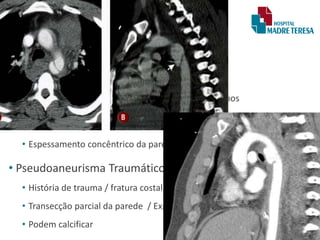 Diagnóstico Diferencial
• Arterite de Takayasu
• Estreitamento de origem inflamatória idiopática.
• Estenose segmentar multifocal da aorta e seus ramos
(raramente restrito ao istmo).
• Contorno irregular / ondulado na aorta torácica descendente.
• Espessamento concêntrico da parede com padrão em anel duplo.
• Pseudoaneurisma Traumático Crônico
• História de trauma / fratura costal / outras fraturas
• Transecção parcial da parede / Expansão temporal
• Podem calcificar
 
