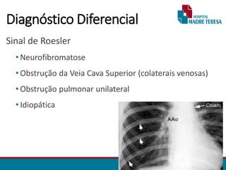 Diagnóstico Diferencial
Sinal de Roesler
• Neurofibromatose
• Obstrução da Veia Cava Superior (colaterais venosas)
• Obstrução pulmonar unilateral
• Idiopática
 