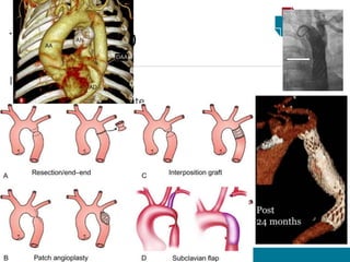 Indicações:
• Hipertensão persistente
• Estenose hemodinamicamente significativa
• Intenção de engravidar
Correção cirúrgica
• Anastomose ponta a ponta
• Aortoplastia com flap da subclávia esquerda
• Próteses / Enxertos
TRATAMENTO
 