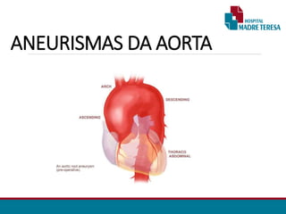 ANEURISMAS DA AORTA
 