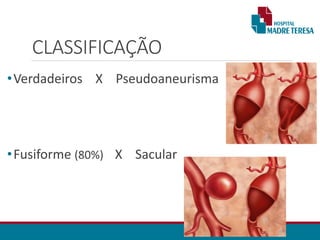 CLASSIFICAÇÃO
•Verdadeiros X Pseudoaneurisma
•Fusiforme (80%) X Sacular
 