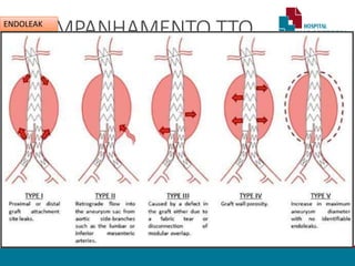 ACOMPANHAMENTO TTO
ENDOVASCULAR
• Angio TC (pré contraste / Arterial / Tardia)
• Controle: 3 / 6 / 18 / 24 meses / anual
•Endoleak
• Não redução ou aumento do diâmetro do aneurisma
• Classificação
•Outros
• Estenose da luz da prótese
• Trombose da Luz / ramificações da prótese
• Migração / angulação
• Dissecção de vaso
ENDOLEAK
 