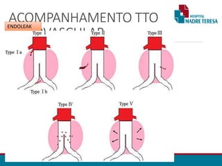 ACOMPANHAMENTO TTO
ENDOVASCULAR
• Angio TC (pré contraste / Arterial / Tardia)
• Controle: 3 / 6 / 18 / 24 meses / anual
•Endoleak
• Não redução ou aumento do diâmetro do aneurisma
• Classificação
•Outros
• Estenose da luz da prótese
• Trombose da Luz / ramificações da prótese
• Migração / angulação
• Dissecção de vaso
ENDOLEAK
 