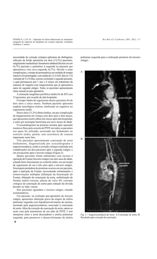 FONSECA, L ET AL - Operação de Glenn bidirecional no tratamento                             Rev Bras Cir Cardiovasc 2005; 20(1): 1-7
estagiado da síndrome de hipoplasia do coração esquerdo: resultados
imediatos e tardios




necessidade de correção cirúrgica (plicatura do diafragma),           pulmonar esquerda para a realização posterior do terceiro
infecção da ferida operatória em dois (13,3%) pacientes,              estágio.
sangramento mediastinal e hematoma subdural discreto em um
(6,7%) paciente e quilotórax à esquerda no paciente que
apresentava veia cava esquerda (6,7%). Devido a estas
complicações, o tempo de permanência em unidade de terapia            A
intensiva foi prolongado, com média de 12,3±9,01 dias (n=12)
variando de 3 a 39 dias, mesmo excluindo o segundo paciente,
o qual permaneceu por 1 ano e 6 meses em tratamento da
estenose de traquéia com traqueostomia que já apresentava
antes do segundo estágio. Todos os pacientes apresentaram
ritmo sinusal no pós-operatório.
    A saturação sangüínea periférica média foi de 82% nos
13 pacientes, por ocasião da alta hospitalar.
    O tempo médio de seguimento destes pacientes foi de
dois anos e cinco meses. Nenhum paciente apresenta
seqüela neurológica motora, intelectual ou cognitiva no
seguimento tardio.
    Houve dois (13,3%) óbitos tardios, um por complicação
de traqueostomia em criança com dois anos e dois meses,
que apresentou morte súbita três meses após alta hospitalar,
e outro por meningite bacteriana aos nove meses de idade.
    O ecocardiograma na primeira semana após operação
mostrava fluxo pelo enxerto de PTFE em todos os pacientes
nos quais foi utilizado, ocorrendo seu fechamento no
controle tardio, porém, sem ocorrência de cianose
importante nesta fase.
                                                                      B
    Três pacientes apresentaram coarctação de aorta
tardiamente, diagnosticada por ecocardiograma e
angiorressonância, sendo a correção cirúrgica realizada sem
complicações em dois pacientes após o segundo estágio, e
em um paciente após o terceiro estágio (Figura 2).
    Quatro pacientes foram submetidos com sucesso à
operação de Fontan (terceiro estágio) aos dois anos de idade,
estando bem clinicamente no controle tardio, em um tempo
de seguimento de um a três anos após o terceiro estágio.
Enteropatia perdedora de proteínas ocorreu em um paciente,
após a operação de Fontan, necessitando reinternações e
reintervenções múltiplas (dilatação da fenestração do
Fontan, dilatação da coarctação da aorta, embolização de
fístulas artério-venosas, plastia da valva AV, correção
cirúrgica de coarctação de aorta) para redução da elevada
pressão no lado venoso.
    Sete pacientes aguardam o terceiro estágio, estando
assintomáticos.
    Um paciente, na avaliação pré-operatória do terceiro
estágio, apresentou obstrução grave da origem da artéria
pulmonar esquerda com hipodesenvolvimento da mesma,
mostrado pela angioressonância, associado à coarctação
de aorta. Além da correção da coarctação de aorta, optou-se
neste caso pela anastomose de um tubo de PTFE 5 mm
interposto entre a aorta descendente e artéria pulmonar               Fig. 2 – Angiorressonância do tórax. A-Coarctação de aorta. B-
esquerda, para promover o desenvolvimento da artéria                  Resultado após correção da coarctação.
 4
 