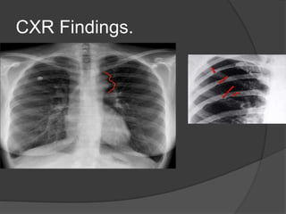 coarctation-of-aorta-pptx