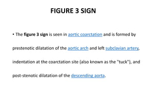 Investigations for Coarctation of aorta | PPTX