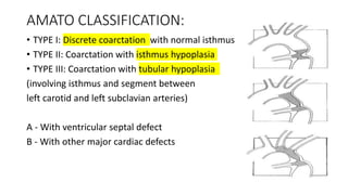 Coarctation of aorta.pptx