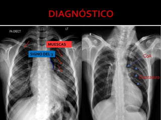 Coartación de la aorta | PPTX