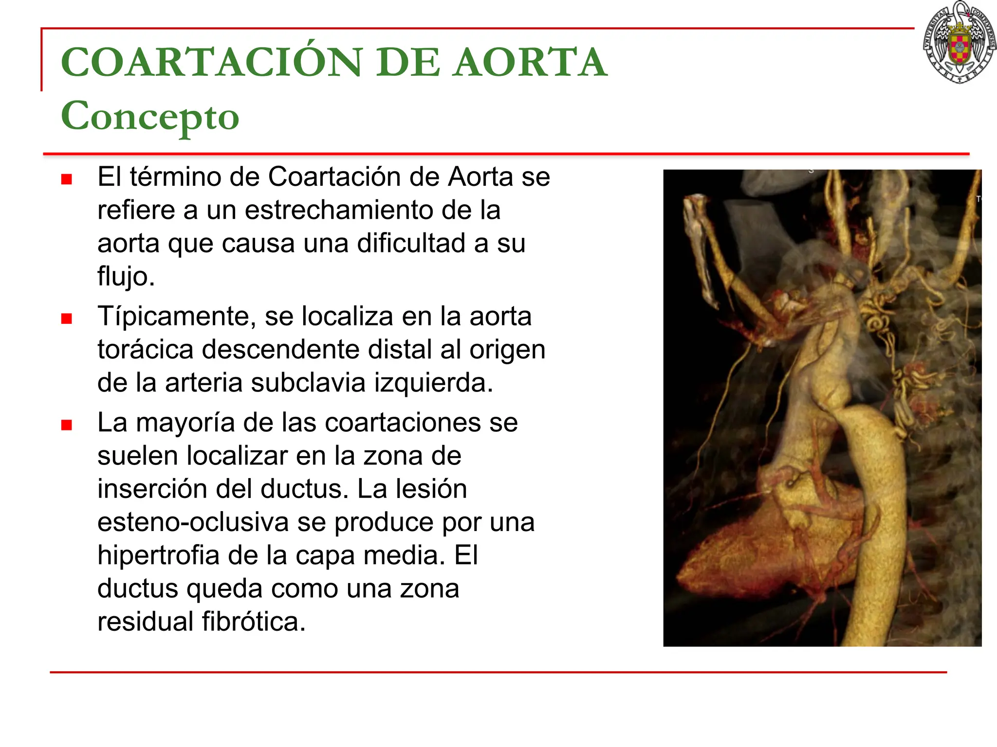 Coartacion-de-Aorta diagnóstico clasificación ppt.pdf