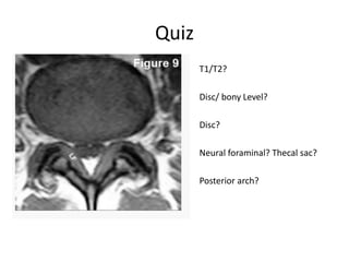 T2 Disc how to read spine mri | PPTX