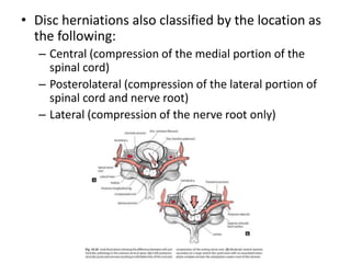 Disc Compression Mri how to read spine mri | PPTX