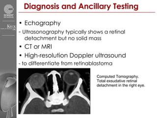 Diagnosis and Ancillary Testing Echography -  Ultrasonography typically shows a retinal detachment but no solid mass CT or MRI High-resolution Doppler ultrasound - to differentiate from retinablastoma Computed Tomography.  Total exsudative retinal  detachment in the right eye.  