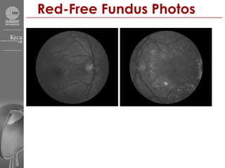 Red-Free Fundus Photos 