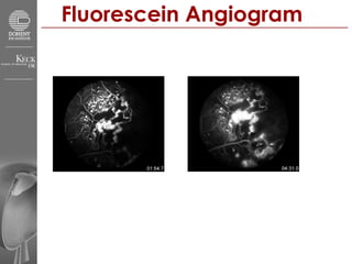 Fluorescein Angiogram 