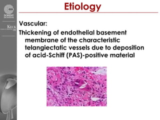 Etiology Vascular: Thickening of endothelial basement membrane of the characteristic telangiectatic vessels due to deposition of acid-Schiff (PAS)-positive material 
