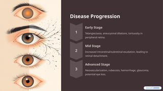 Disease Progression
Early Stage
Telangiectasia, aneurysmal dilations, tortuosity in
peripheral retina.
Mid Stage
Increased intraretinal/subretinal exudation, leading to
retinal detachment.
Advanced Stage
Neovascularization, rubecosis, hemorrhage, glaucoma,
potential eye loss.
 