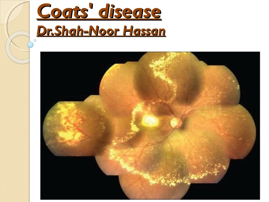 Coats' Disease