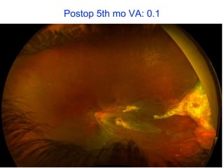 Postop 5th mo VA: 0.1
 