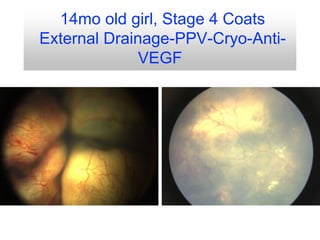 14mo old girl, Stage 4 Coats
External Drainage-PPV-Cryo-Anti-
VEGF
 