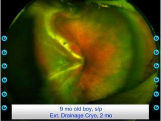 9 mo old boy, s/p
Ext. Drainage Cryo, 2 mo
 