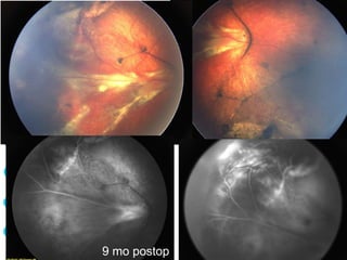 9 mo old boy, s/p Drainage Cryo, 6 mo
9 mo postop
 